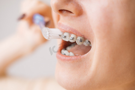 牙齿上戴着牙套的年轻女子用牙刷刷牙，特写。