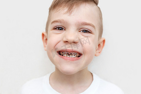 男孩有龋齿的牙齿的特写镜头。
