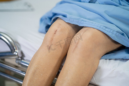 老女性摄影照片_亚洲老年或老年老妇女患者在护理医院病房的床上展示了她的疤痕手术全膝关节置换缝合伤口手术关节成形术，健康强大的医疗理念。