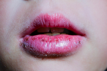 装饰性摄影照片_嘴唇干裂导致角部受伤 皮肤干燥问题与口腔疾病