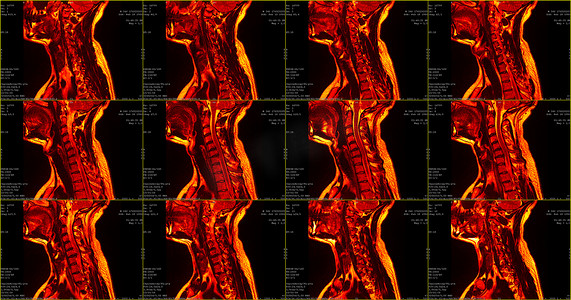 一组 12 幅矢状红色 MRI 扫描，扫描对象为 34 岁白人男性，其颈部区域有 C6-C7 节段双侧旁内侧突出