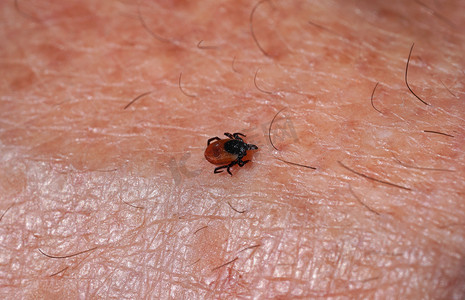 小蜱虫蓖麻在人体皮肤上爬行