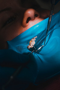 在橡皮障、橡皮障和牙镜的绝缘体上用白色复合树脂填充牙齿后患者口腔的特写。