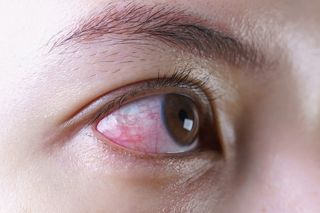 妇女充血的红眼，被激怒或感染，结膜炎