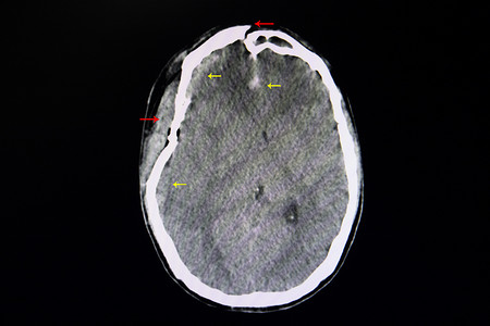 颅脑损伤患者 CT 大脑