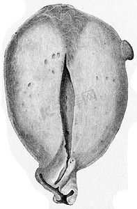 子宫肌瘤摄影照片_子宫部分显示均匀的肌瘤性增大，vin