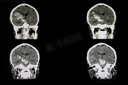 块状摄影照片_急性出血性中风患者布赖恩的 CT 扫描