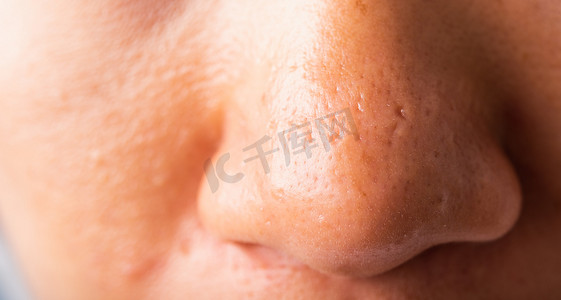 皮肤上的细菌摄影照片_女性毛孔粗大，脸上有雀斑，脸颊油腻，鼻子上长粉刺
