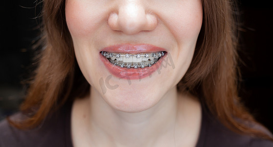 笑容牙齿摄影照片_一个年轻女孩的笑容，洁白的牙齿上戴着牙套。