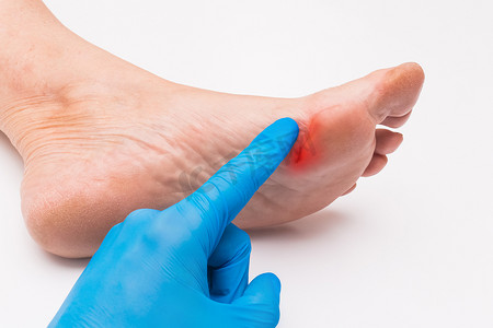 一名医生戴着防护性医用手套，用手指触摸自己的手，检查白色背景下一位老年妇女脚上的伤口。