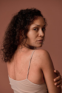 在彩色背景上特写肖像，复制广告空间，一位穿着米色上衣的漂亮女人拥抱自己，看着相机显示她背部的皮肤问题。