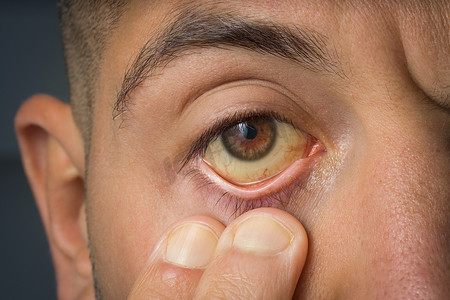 由于胆红素水平高、肝硬化或肝炎，病人检查黄眼睛。