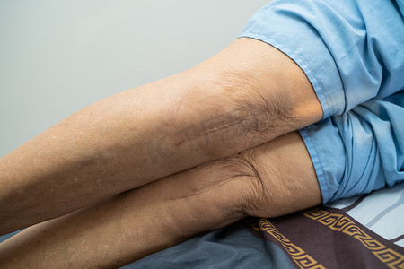 老女性摄影照片_亚洲老年或老年老妇女患者在护理医院病房的床上展示了她的疤痕手术全膝关节置换缝合伤口手术关节成形术，健康强大的医疗理念。