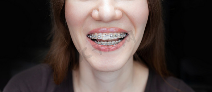 一个年轻女孩的笑容，洁白的牙齿上戴着牙套。