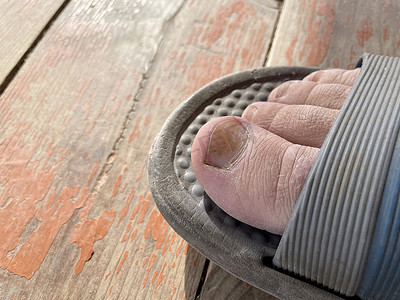 男性右腿的指甲被真菌损坏