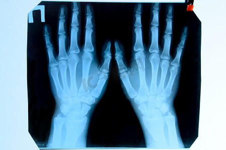 手部x光片摄影照片_手部 X 光片，X 光片上手部骨骼的图片。