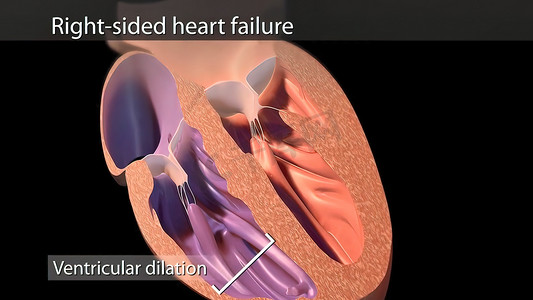 插图充血性心力衰竭