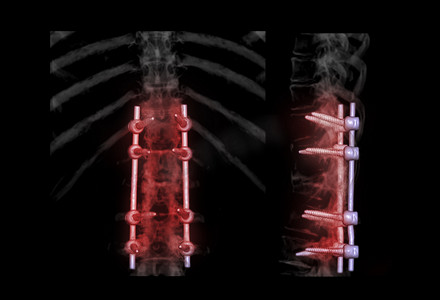腰椎手术摄影照片_腰椎 AP 和侧视图，用于诊断椎管狭窄和退行性椎间盘疾病，显示手术减压和脊柱融合后椎弓根螺钉植入。