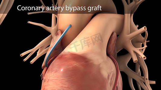 冠状动脉搭桥手术是使用称为移植物的健康血管进行的。