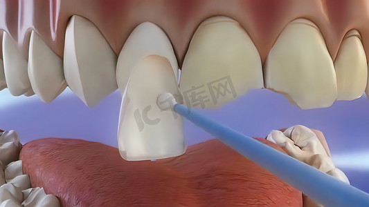 牙科诊所摄影照片_损坏牙齿的破碎过程