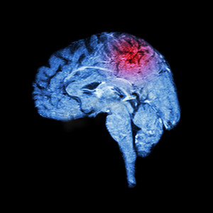 眼球成像摄影照片_大脑和中风的磁共振成像 (MRI)（医学、科学和保健概念）