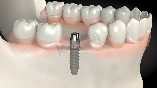 牙种植手术。