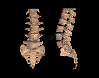 脊柱退变摄影照片_CT 腰椎或 L-S 脊柱 3D 渲染图像前视图、后视图和侧视图。