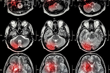 脑中风种类摄影照片_脑部 MRI（磁共振成像）胶片（中风、脑肿瘤、脑梗塞、脑出血）（医疗、保健、科学背景）（大脑横截面）脑部 MRI（磁共振成像）胶片（中风）