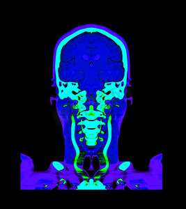 新冠状病毒表情包摄影照片_收集彩色脑 CT 血管造影或 CTA 脑比较冠状视图。