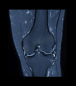 膝关节 MRI 或膝关节磁共振成像搅拌技术的轴向、矢状和冠状视图对脂肪抑制的比较。