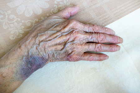 一位老妇人的手有瘀伤