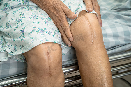 高价置换摄影照片_亚洲老年或老年老妇女患者在护理医院病房的床上展示了她的疤痕手术全膝关节置换缝合伤口手术关节成形术，健康强大的医疗理念。