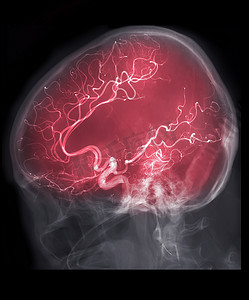 介入放射学中荧光透视的脑血管造影 AP 视图图像。