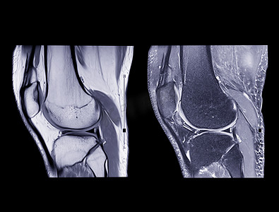 磁共振成像或 MRI 膝盖比较矢状 PDW 和 TIW 视图。