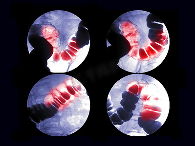 卤水大肠摄影照片_钡灌肠或 BE 是在荧光镜控制下将钡造影剂注射到结肠后的大肠图像