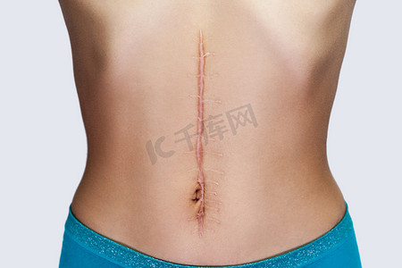 腹部手术后有大疤痕的年轻女子的特写。