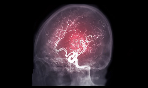 脑血管造影 AP，介入放射学透视透视显示脑动脉的斜视图和侧视图图像。