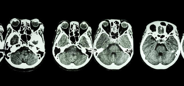 脑及颅底CT扫描（显示眼睛、筛窦、小脑、大脑等结构）