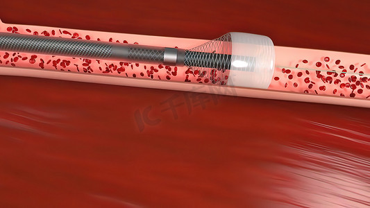 血管闭塞是血管的堵塞，通常伴有血栓。