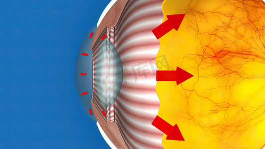 堵住摄影照片_蓝色背景上的 3D 医学动画正常眼压青光眼