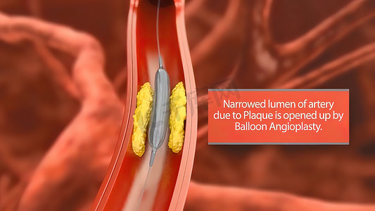 动脉粥样硬化、斑块堆积和动脉内壁动脉增厚 3D 医学插图