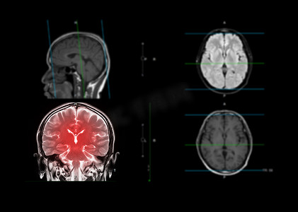冠摄影照片_大脑 MRI 显示大脑的冠状面。