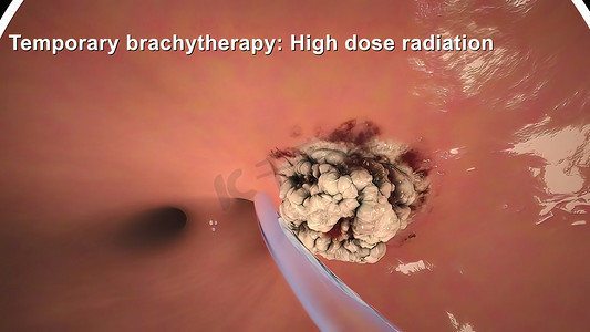 粉色丝带海报摄影照片_通过将放射性植入物直接植入组织来治疗癌症。