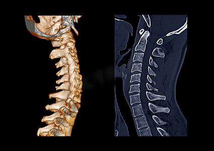 CT C-Spine 或颈椎 3D 渲染图像与矢状面的比较