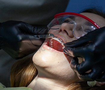 一位女士在看牙医时用牙套代替牙弓