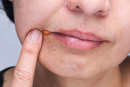 口角炎是一种常见的唇部炎症
