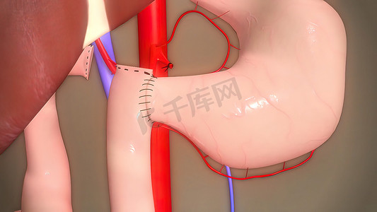 切除术摄影照片_切除肠道任何部分的手术，肠切除术