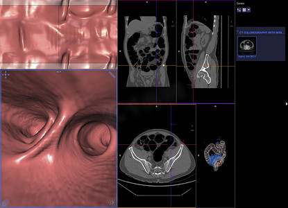 CT 结肠成像或结肠轴向视图与冠状视图和 3D 渲染图像的 CT 扫描