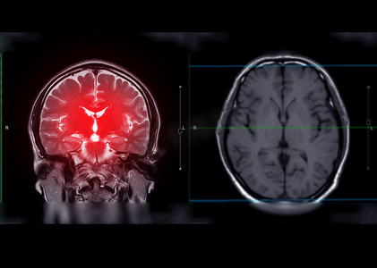 脑中风种类摄影照片_MRI 脑冠状 T2W 平面用于检测中风疾病以及脑肿瘤和囊肿。