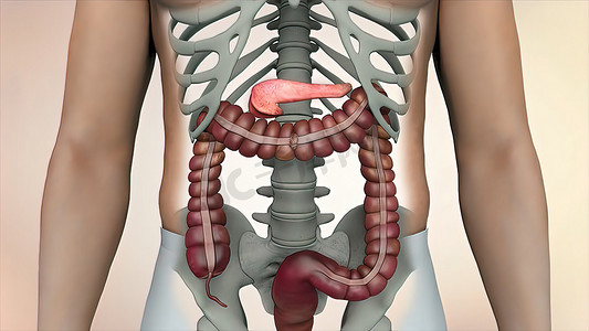 肠道细胞摄影照片_结肠镜检查期间可见肠道或肠癌肿瘤。
